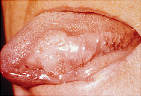 Tongue Cancer Surgery